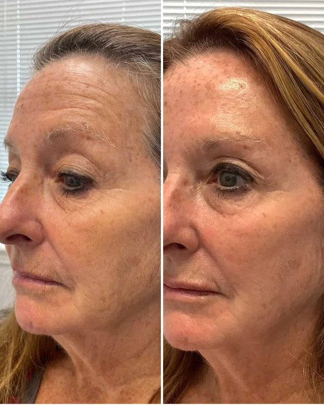 Antes e depois do perfil de uma cliente, com o vinco da boca mais suave