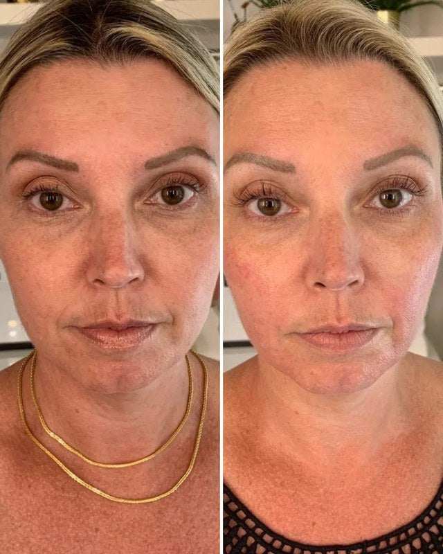 Antes e depois do rosto de frente de uma cliente, com o bigode chinês mais suave