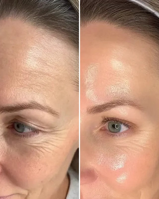 Antes e depois da testa e do canto do olho de uma cliente
