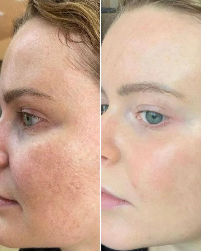 Antes e depois da bochecha de uma cliente, com a pele mais lisa